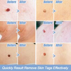 LESCOLTON Auto Skin Tag Remover Painless Mole Wart Remover Skin Tag Removal Kit with Cleansing Swabs Facial Beauty Tool Home Use color: 40 Bands|60 Bands|80 Bands  New Arrivals Uncategorized Skin Care Best Sellers