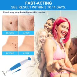 LESCOLTON Auto Skin Tag Remover Painless Mole Wart Remover Skin Tag Removal Kit with Cleansing Swabs Facial Beauty Tool Home Use color: 40 Bands|60 Bands|80 Bands  New Arrivals Uncategorized Skin Care Best Sellers