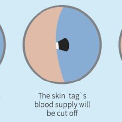 LESCOLTON Auto Skin Tag Remover Painless Mole Wart Remover Skin Tag Removal Kit with Cleansing Swabs Facial Beauty Tool Home Use color: 40 Bands|60 Bands|80 Bands  New Arrivals Uncategorized Skin Care Best Sellers