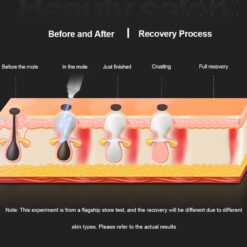 Laser Plasma Pen for Skin Tag Remover Freckle Black Dot Papilloma Warts Mole Pimples Tattoo Removal Laser Pen Beauty Care Tools color: SP1923-GD|SP1923-GD-6|SP1923-PK|SP1923-PK-6|SP1923-WH|SP1923-WH-6  New Arrivals Uncategorized Skin Care Best Sellers